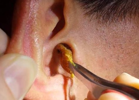Close up of a lump of wax being removed from a man's right ear using tweezers.